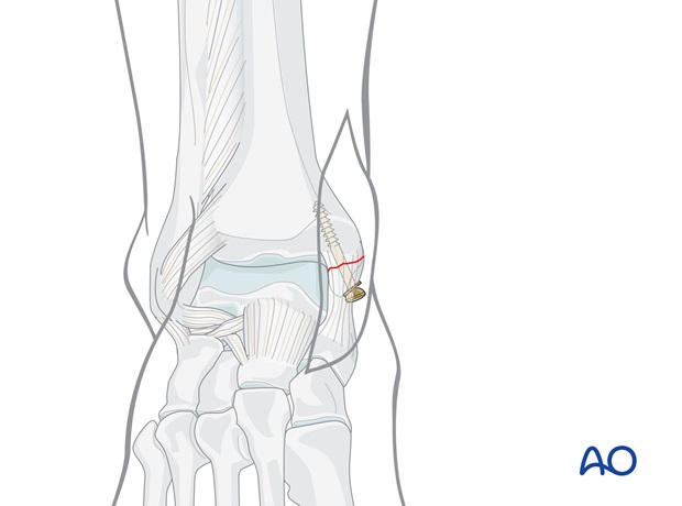 lag screws transverse fracture