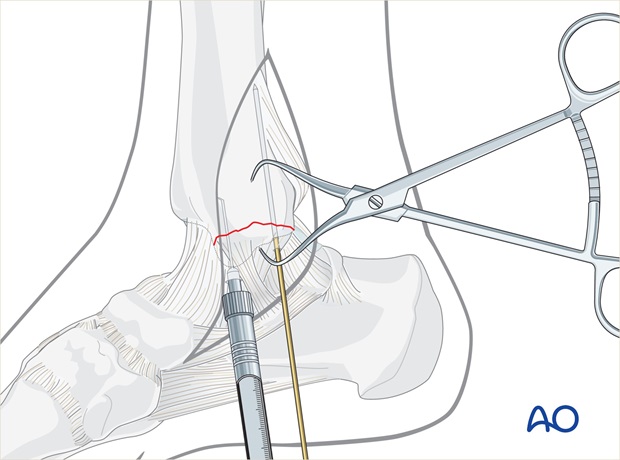 lag screws transverse fracture