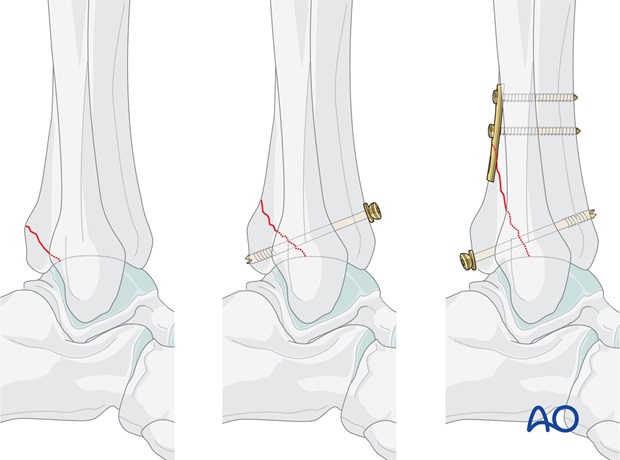 volkmann fracture anterior lag screw