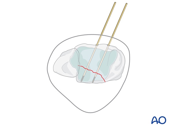 volkmann fracture anterior lag screw