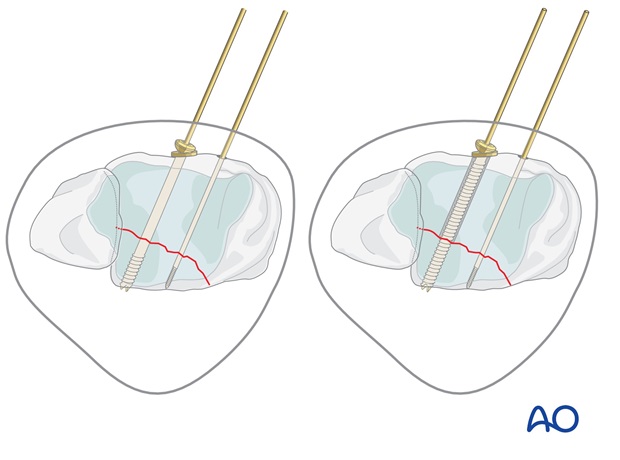 volkmann fracture anterior lag screw