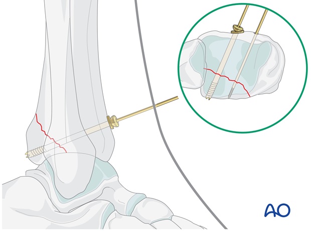 volkmann fracture anterior lag screw