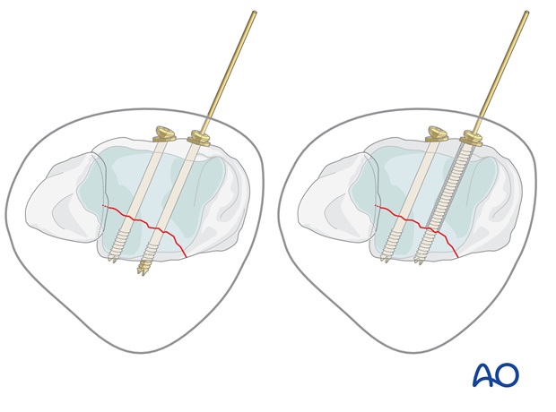 volkmann fracture anterior lag screw