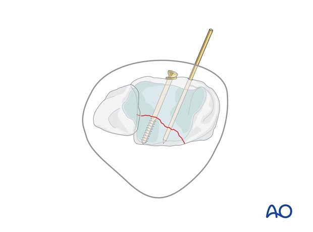 volkmann fracture anterior lag screw