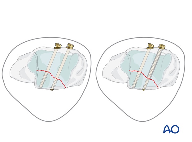 volkmann fracture anterior lag screw