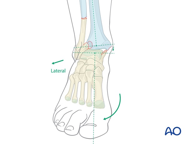 long leg circular cast