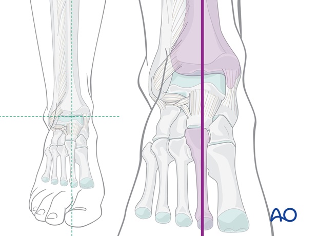 long leg circular cast