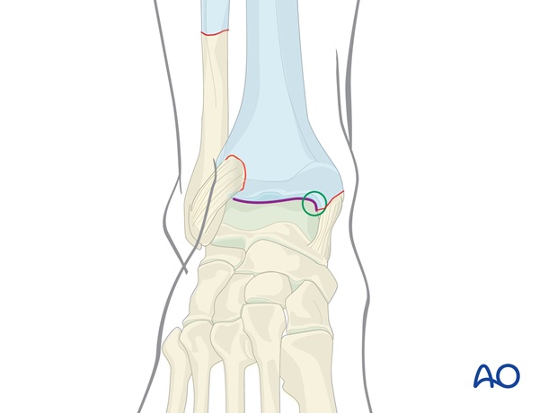 long leg circular cast