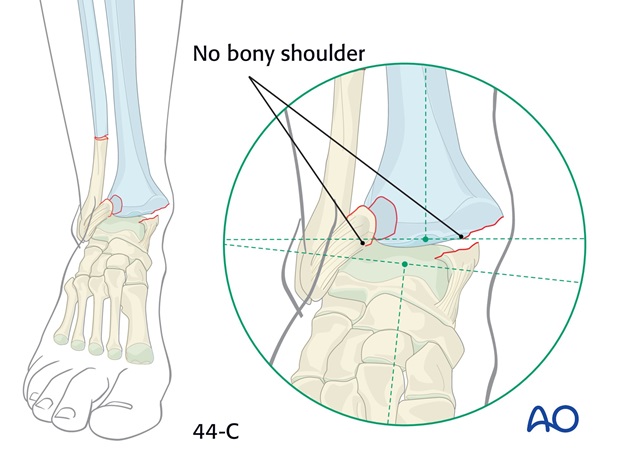 long leg circular cast