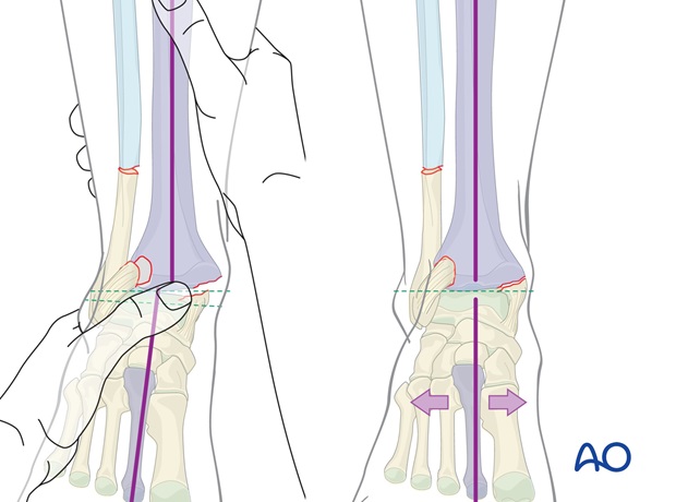 long leg circular cast