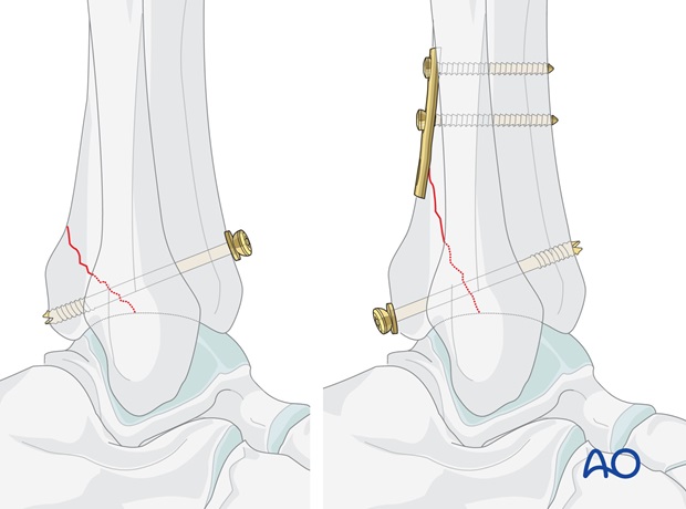 volkmann fracture anterior lag screw