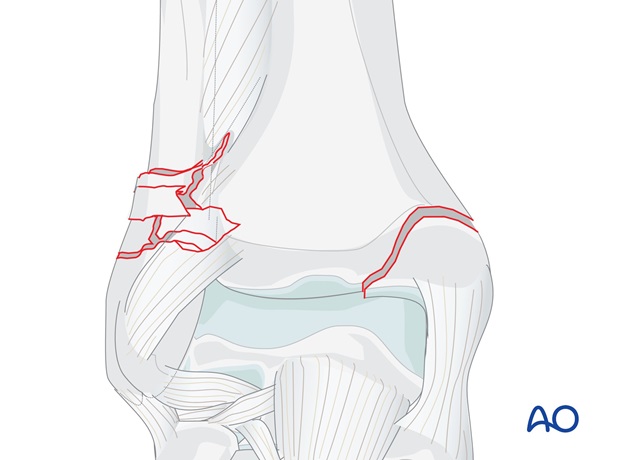 transsyndesmotic lateral multifragmentary fracture with medial injury