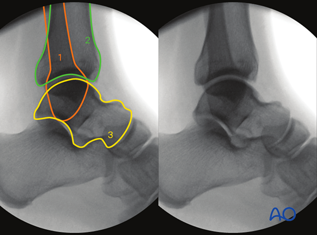 Anatomical landmarks and lines in lateral view of the malleoli