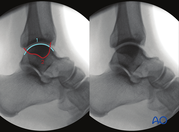 Anatomical landmarks and lines in lateral view of the malleoli