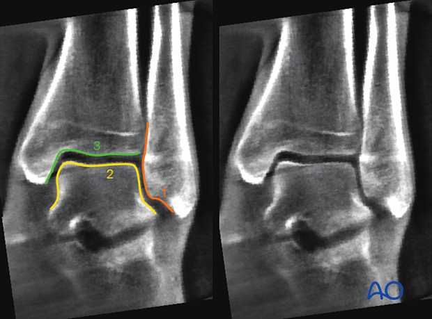 Amatomical landmarks and lines in Coronal plane