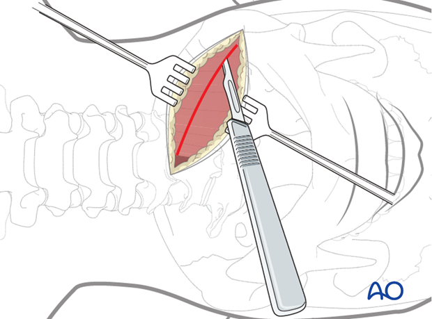 anterior access to c1t2