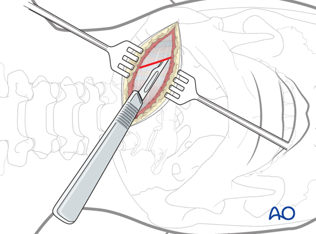 anterior access to c1t2