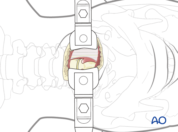 anterior fixation