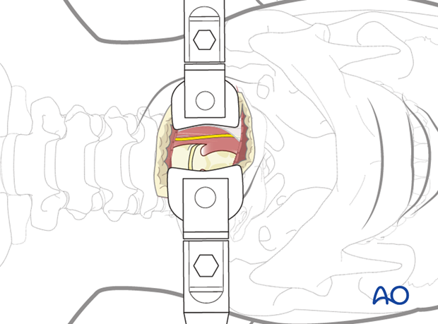 anterior access to c1t2