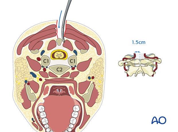 posterior access to c1 c2