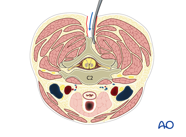 posterior access to c1 c2