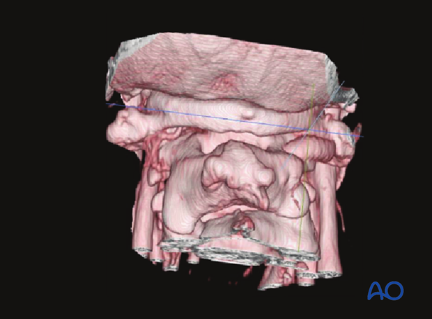 posterior access to c1 c2