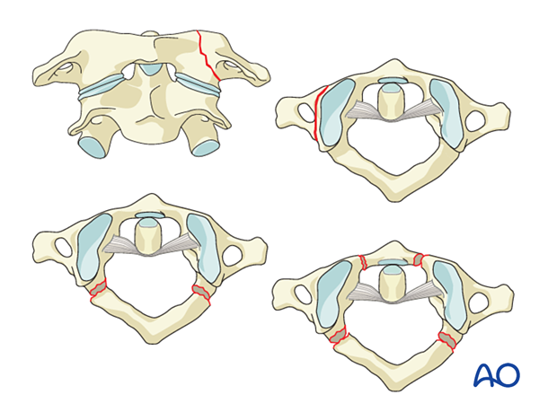 51 X14 ao spine upper cervical injuries classification system