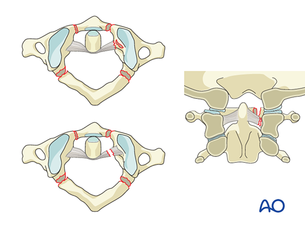 Region II Type B: Non-displaced ligamentous injury of C1 and the C1–C2 joint