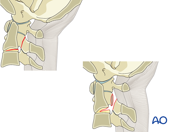 Non-displaced ligamentous injury of C2 and the C2–C3 joint