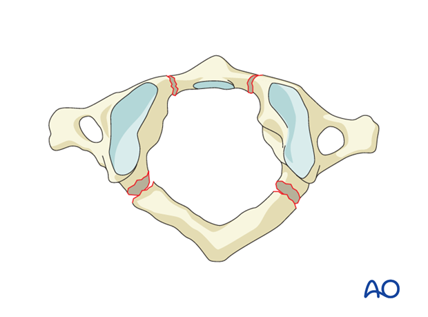 Combined posterior and anterior arch injury