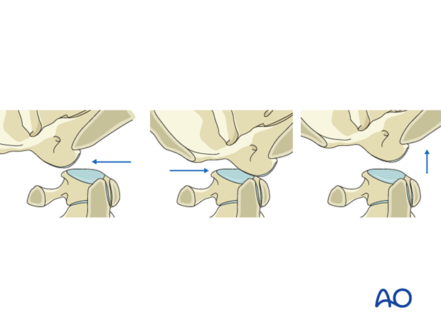 Region 1 Type C: Translation injury of the occipitocervical junction