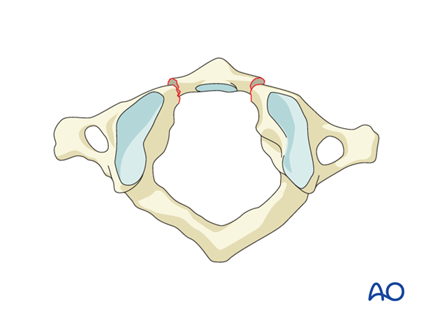 Anterior arch injury