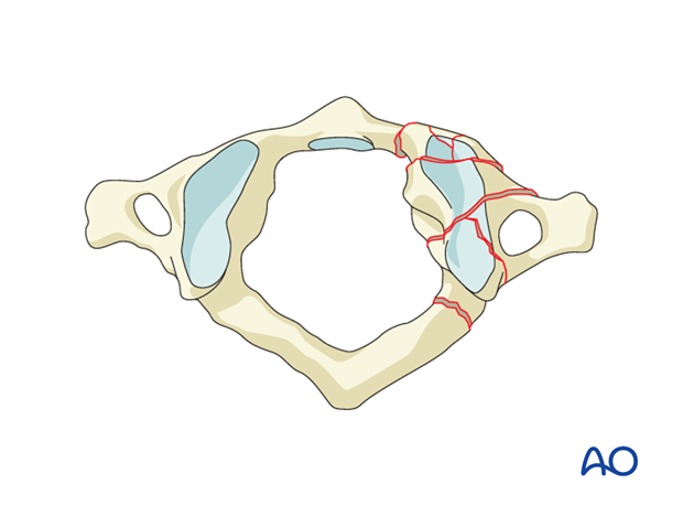 Lateral mass fracture