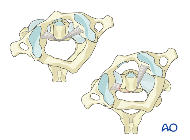 C1–C2 Rotatory subluxation