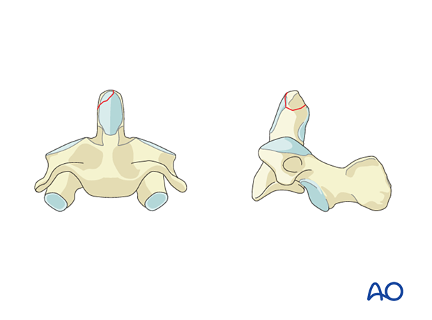 Tip of the dens fracture