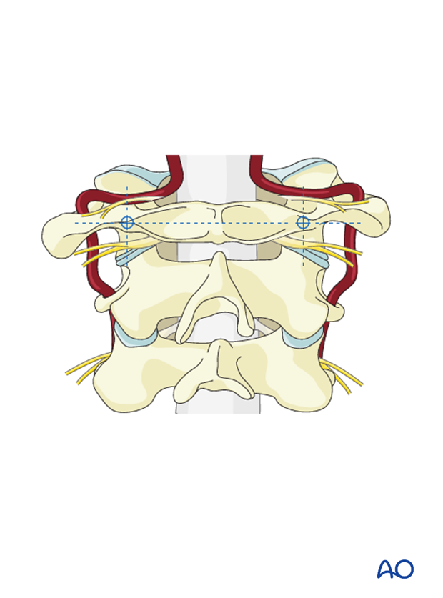 If the posterior arch of C1 is large it is possible to drill through it and into the lateral mass prior to screw insertion