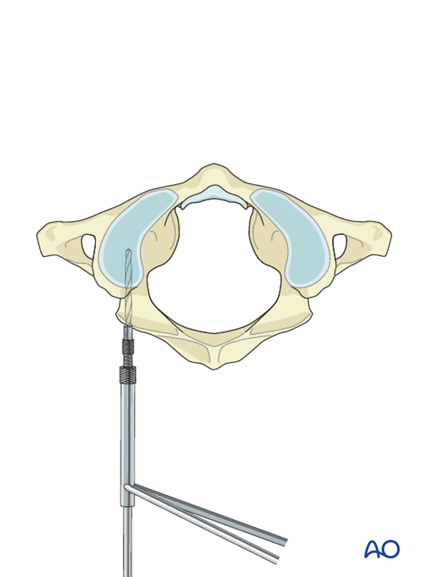 c1 lateral mass screws