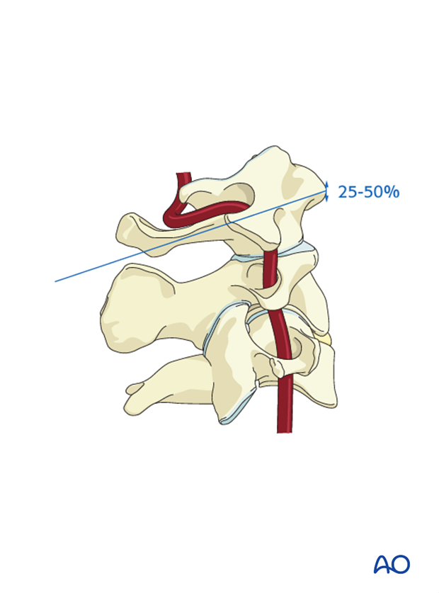 c1 lateral mass screws