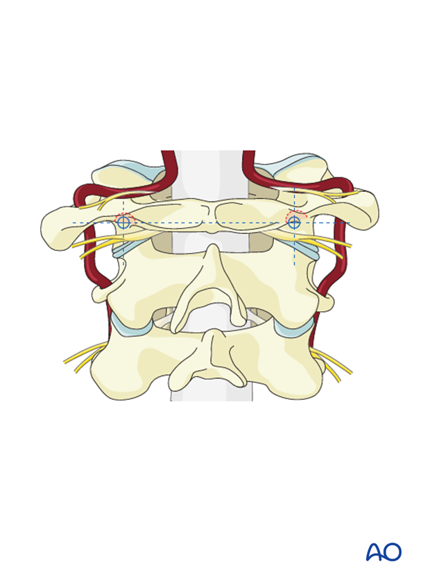 c1 lateral mass screws