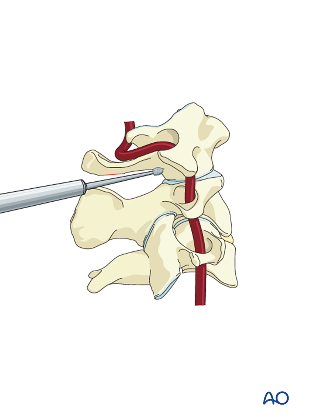 Drilling a starting hole with a burr during C1 lateral mass screw insertion