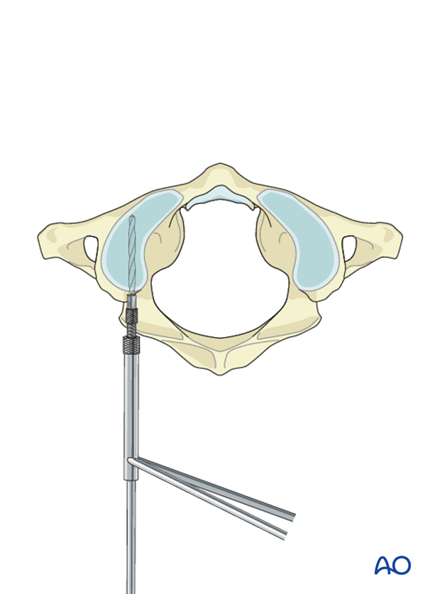 Drilling into the C1 lateral mass prior to screw insertion