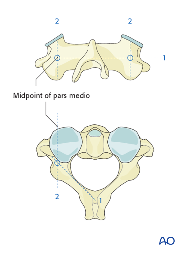 c2 pedicle screw insertion