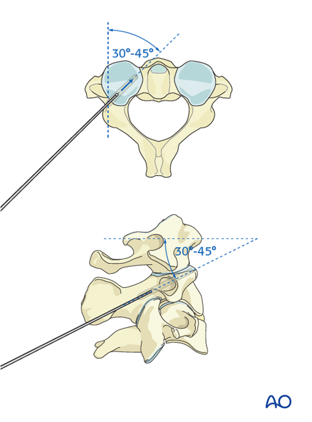 c2 pedicle screw insertion