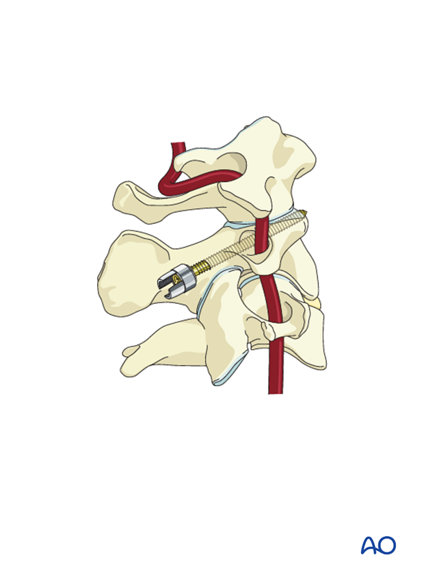 Placing a C2 pedicle screw