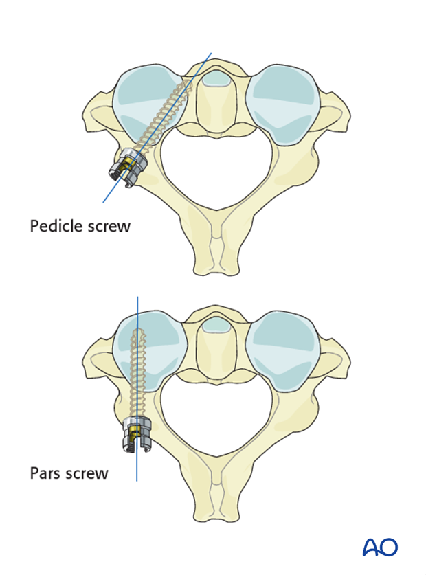 c2 pedicle screw insertion