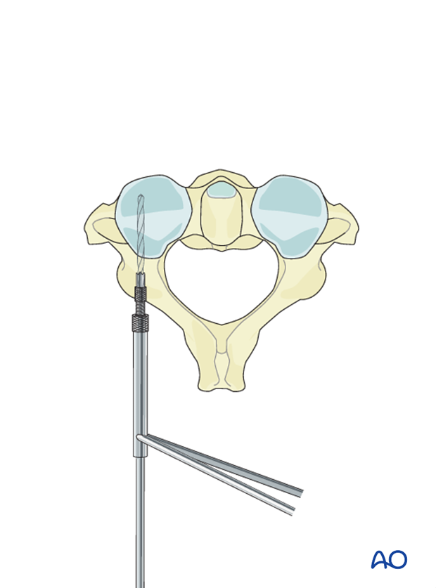 c2 pars screw insertion