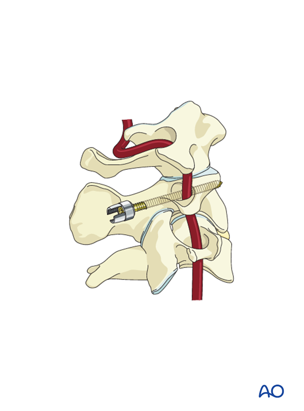 c2 pars screw insertion