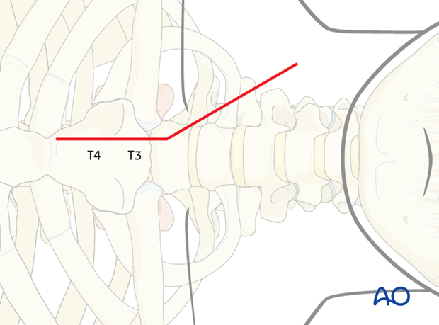 anterior approach to the cervico thoracic junction