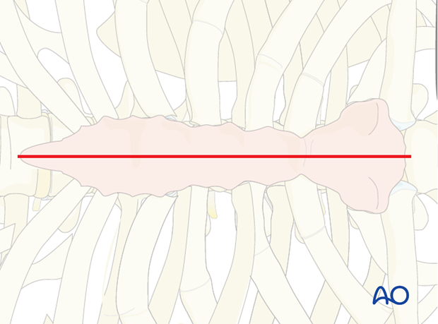 anterior approach to the cervico thoracic junction