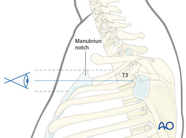 anterior approach to the cervico thoracic junction